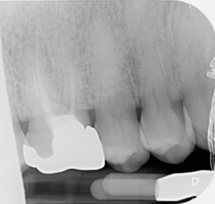 Fractured file removal and re-rct - Pre-op
